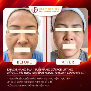 Khách hàng sau khi sử dụng dịch vụ Face Lifting
