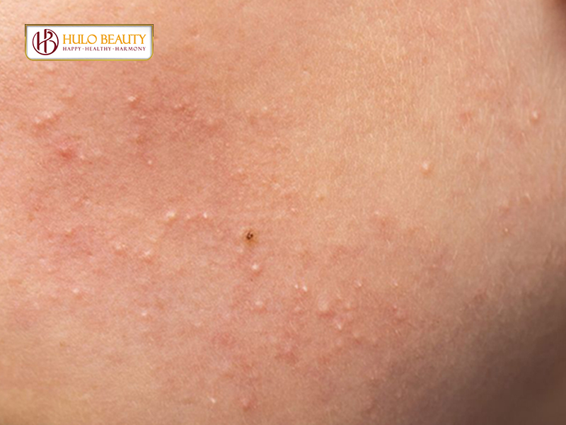 Nguyên nhân và dấu hiệu của mụn ẩn dưới da