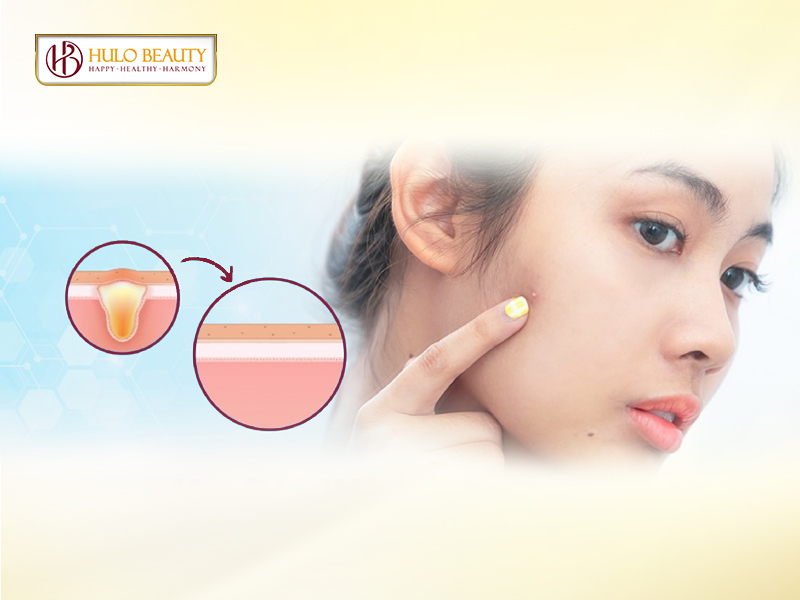 Cách điều trị mụn ẩn dưới da hiệu quả