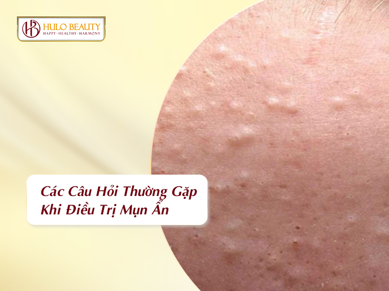Các câu hỏi thường gặp khi điều trị mụn ẩn