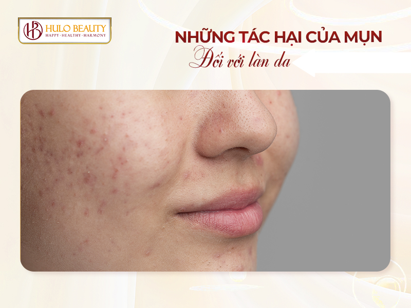 Trị mụn bằng laser: Cơ chế, công nghệ, lợi ích và lưu ý