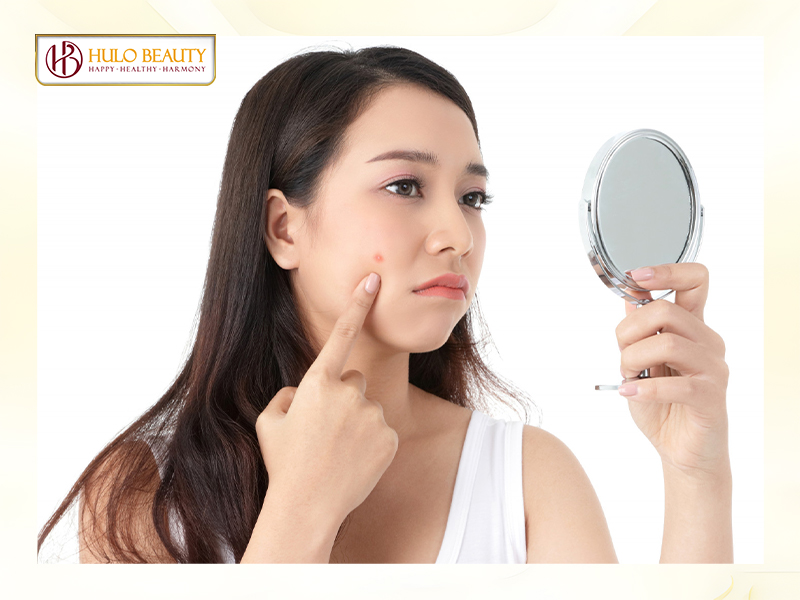 Mụn và những điều cần biết