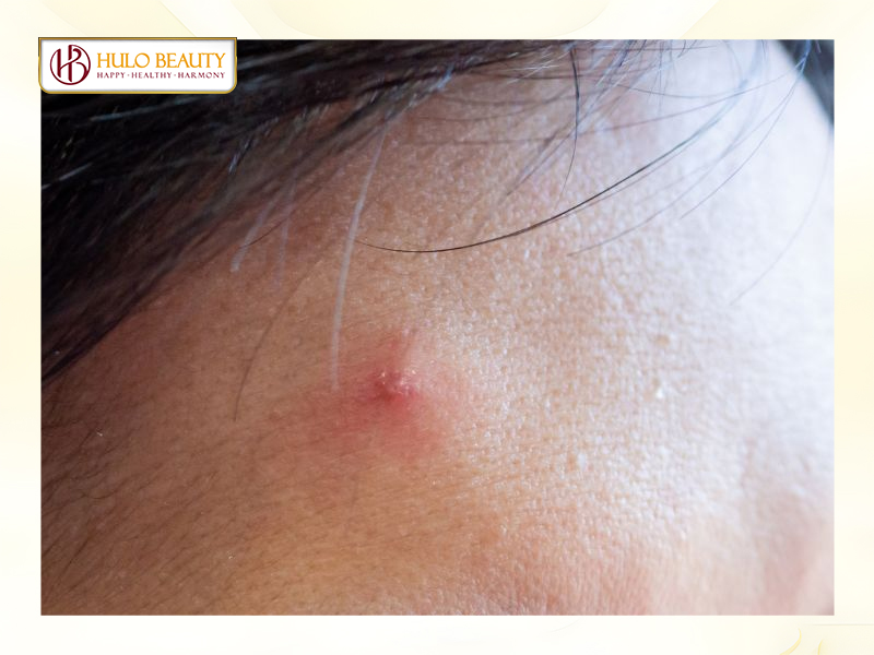 Nguyên nhân gây ra mụn viêm đỏ