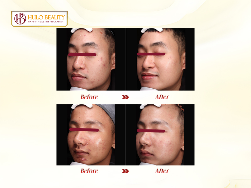 Điều trị mụn hiệu quả tại phòng khám HULO BEAUTY