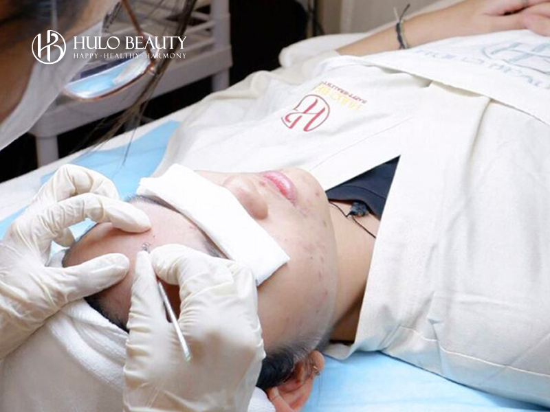 Bước 3: Lấy nhân mụn